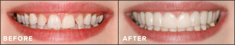Comfortable Flex Dentures for Top & Bottom Teeth | White Cosmetic Cover