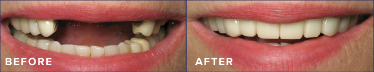 Comfortable Flex Dentures for Top & Bottom Teeth | White Cosmetic Cover