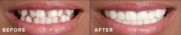Comfortable Flex Dentures for Top & Bottom Teeth | White Cosmetic Cover