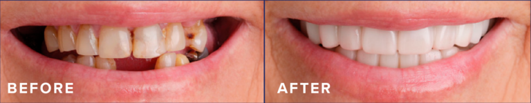 Comfortable Flex Dentures for Top & Bottom Teeth | White Cosmetic Cover